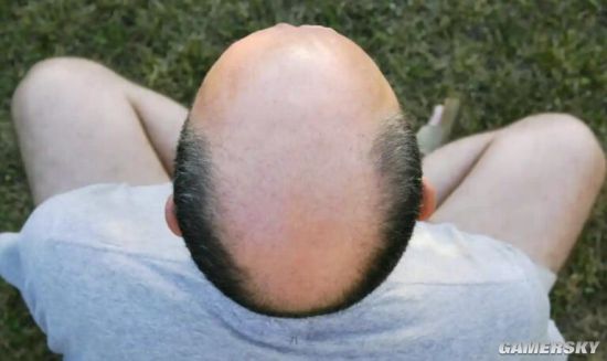 英国法院裁定：称男性“秃头”涉嫌性别歧视