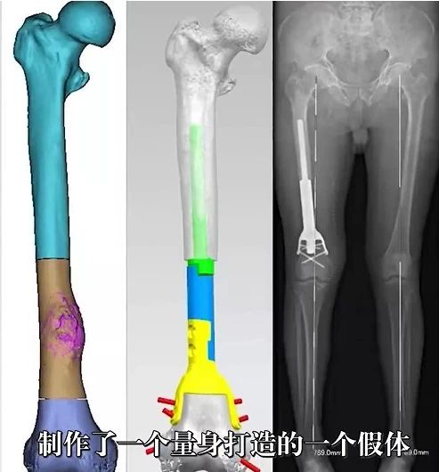 75岁大爷患骨转移瘤 医生3D打印假体为其换骨