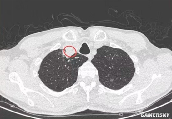 《最后生还者》成真？印度一男子跨物种感染植物真菌