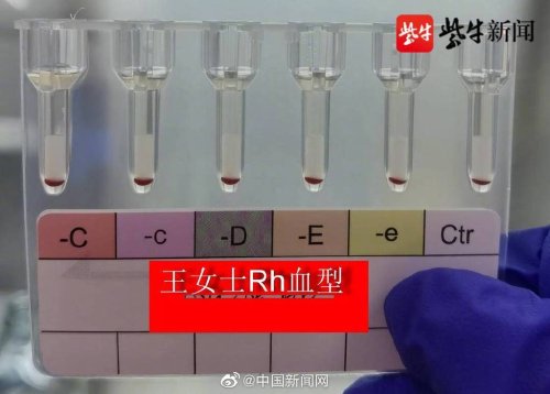 江苏发现2例全球罕见黄金血型 全球不足50例超罕见