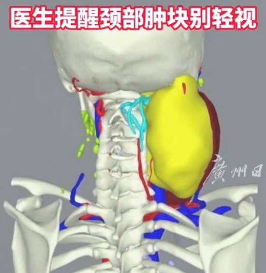 16岁女孩颈部肿瘤2小时疯长至10厘米 医生：颈内静脉被破坏出血所致-女子体检查出2公分肿瘤